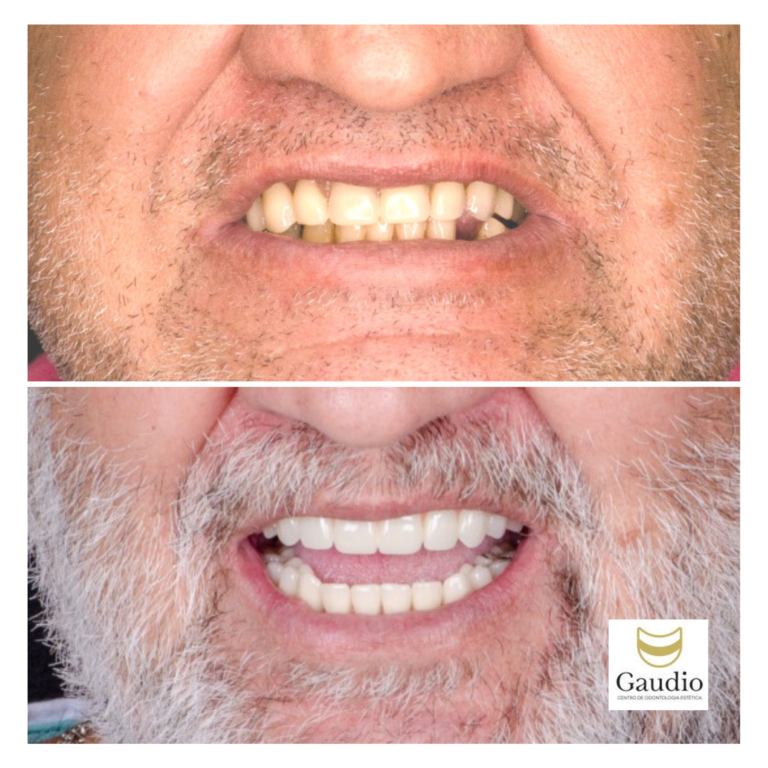 Implante dentário brasília DF