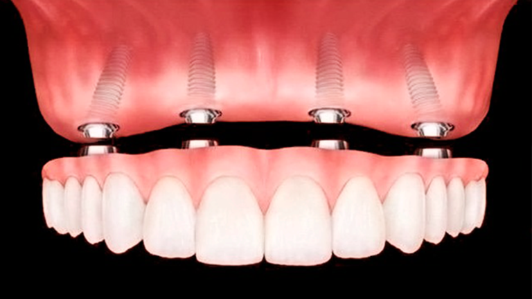 Implante dentário brasília DF