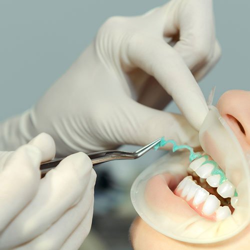 clareamento-dental-em-consultorio-brasilia