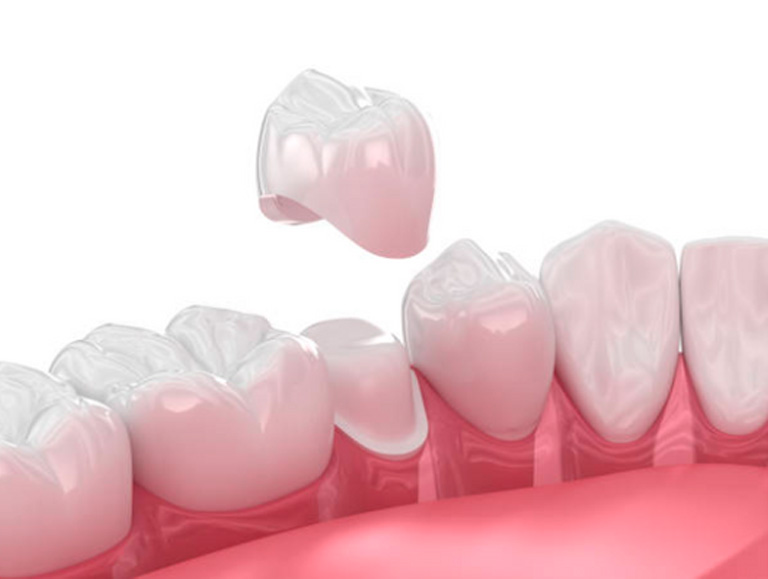 COROA DENTAL EM BRASILIA
