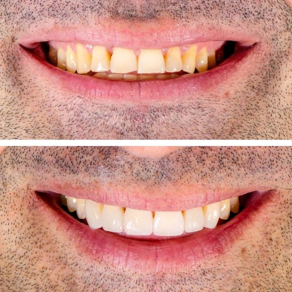 Clareamento e resina