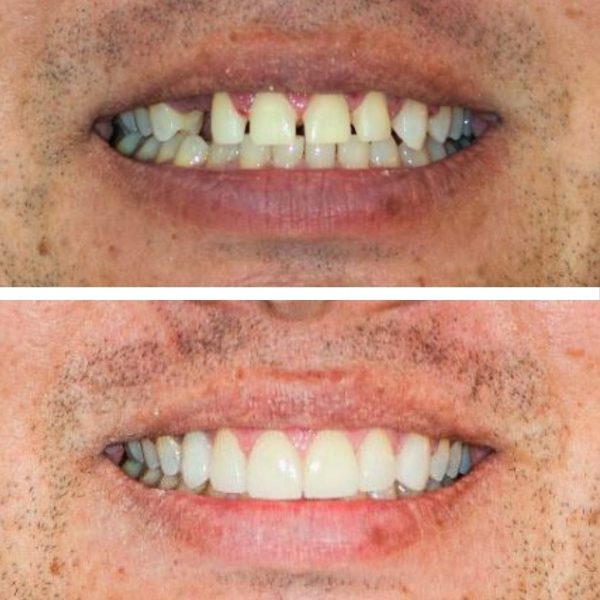 ceramica implante e lente