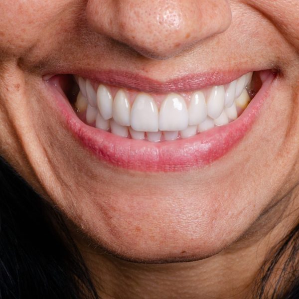 lentes ceramicas final1 pagina