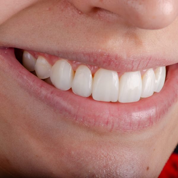 lentes resinas pagina